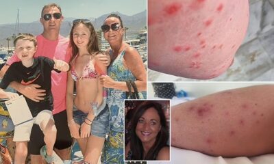 Mother left fighting for life after Tenerife hotel accident caused by mosquito bite