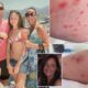 Mother left fighting for life after Tenerife hotel accident caused by mosquito bite